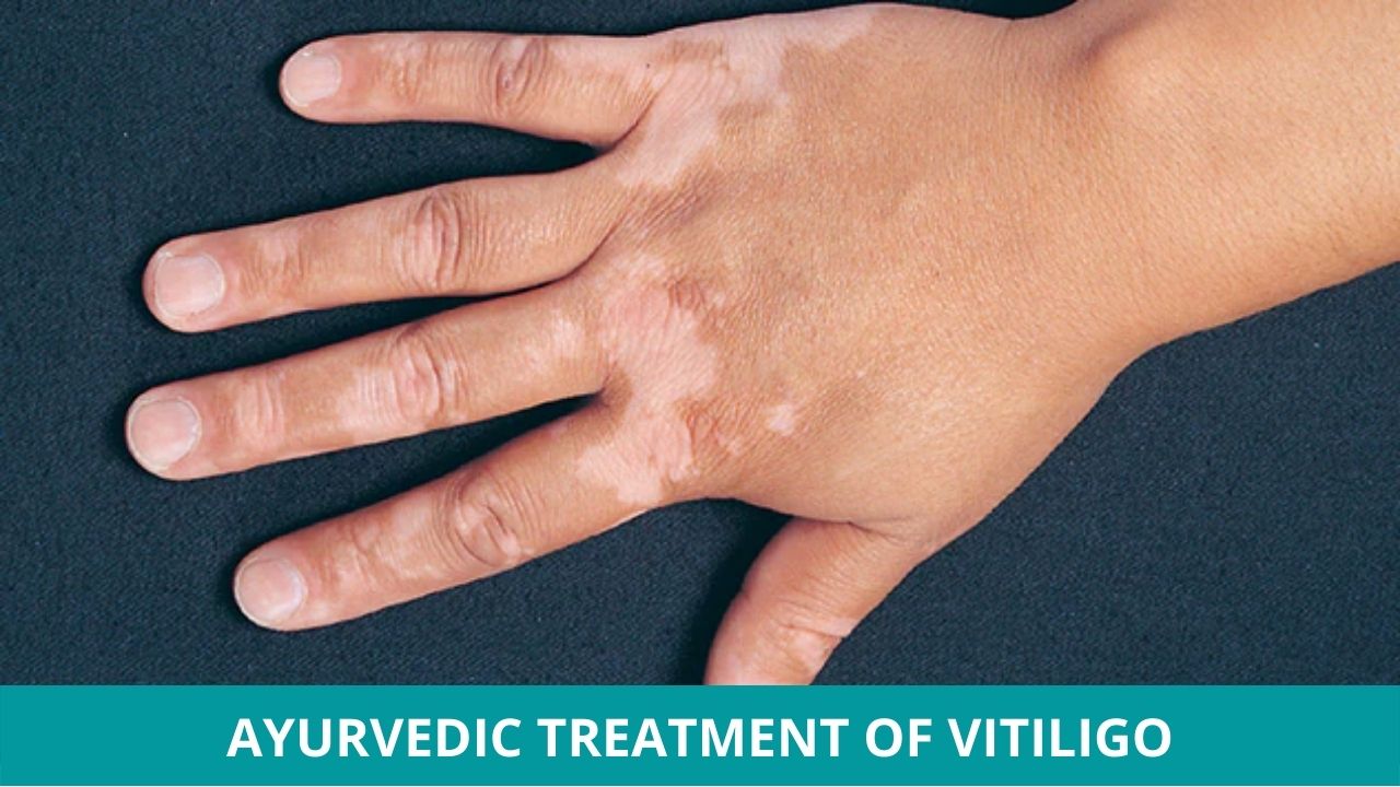 Vitiligo - Causes, Symptoms, and Ayurvedic Treatment