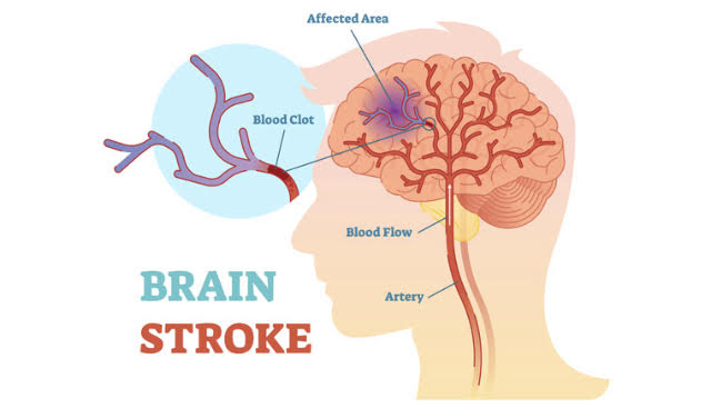 Ayurvedic Stroke Prevention and Management