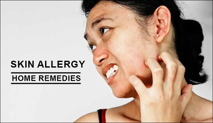 Home Remedies for Skin Allergies