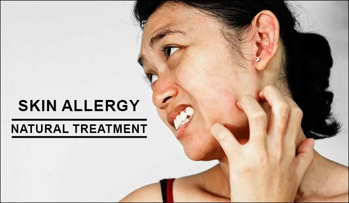 5 Ways to Treat Your Skin Allergy Naturally | Ayurvedic Treatment
