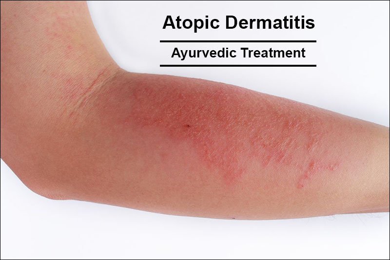 Doktor i filosofi blåhval Puno How to Treat Atopic Dermatitis in Ayurveda Naturally?