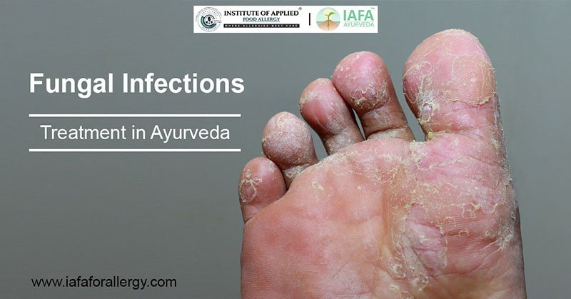 Ayurvedic treatment for fungal infections