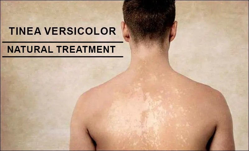 Natural Treatment For Tinea Versicolor - Safest Way To Heal It