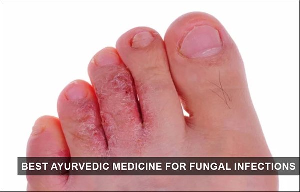 Best Ayurvedic Medicine for Fungal Infections