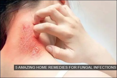 5 Amazing Home Remedies for Fungal Infections