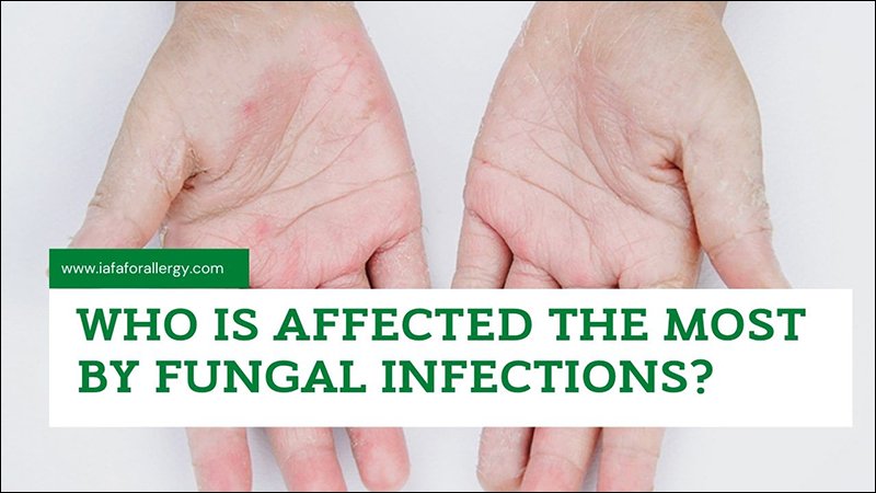 Fungal Infections Fungal Infections