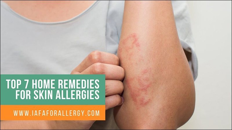 Top 7 Home Remedies for Skin Allergies