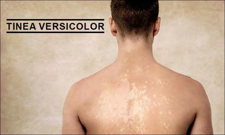 Tinea Versicolor Tinea Versicolor