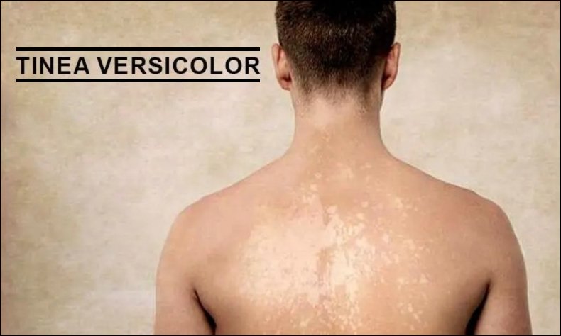 What Happens if Tinea Versicolor is Left Untreated?