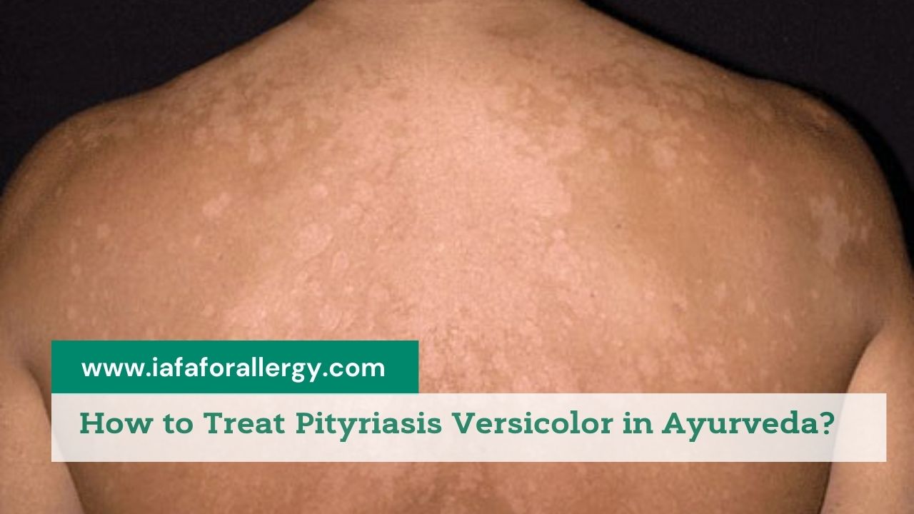 Treat Pityriasis Versicolor