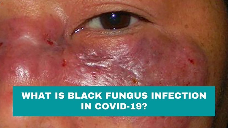 Black Fungus Infection in Covid-19