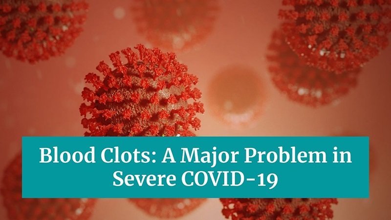Blood Clots - A Major Problem in Severe COVID-19