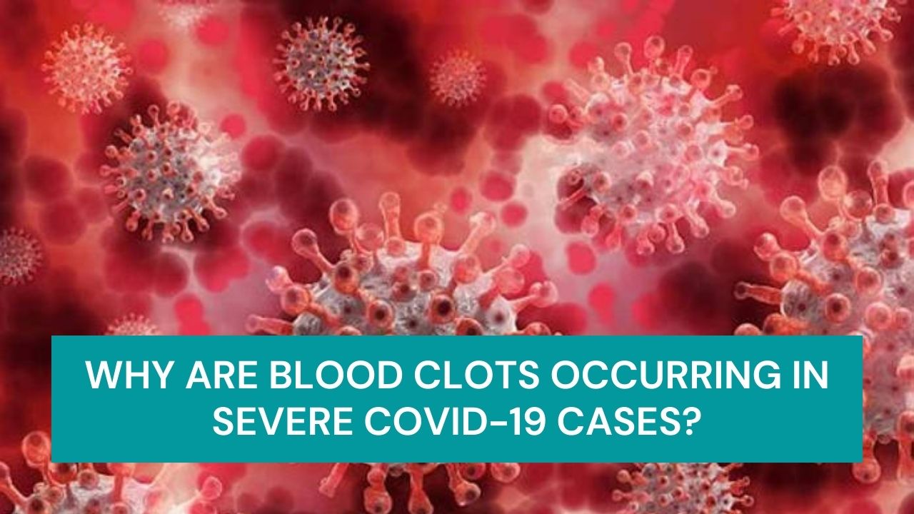 Covid-19 and Blood Clots