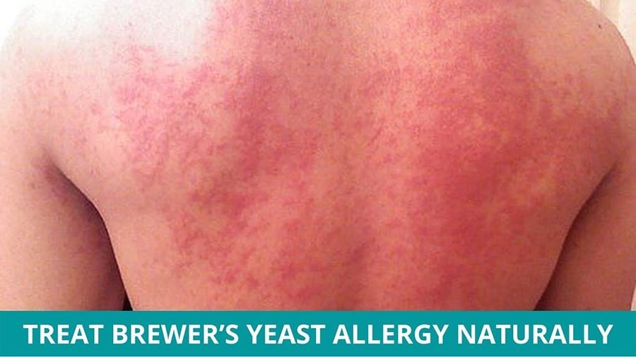 Treat Brewer’s Yeast Allergy Naturally