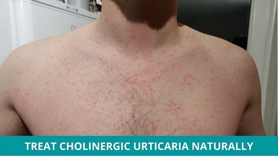 Treat Cholinergic Urticaria Naturally