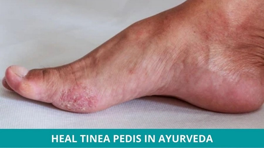 Effective Ayurvedic Treatment of Tinea Pedis (Athlete's Foot)