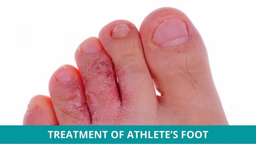 Ayurvedic Treatment of Athletes Foot