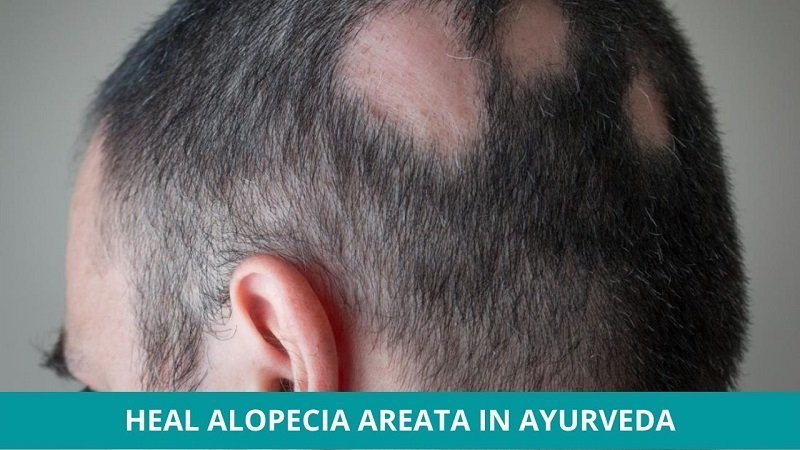 How to Heal Alopecia Areata in Ayurveda?
