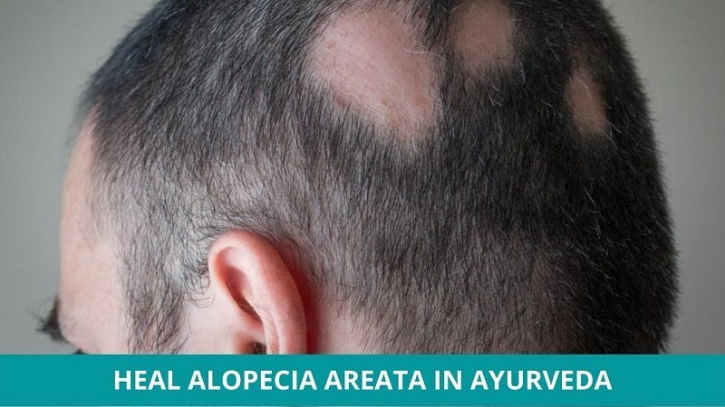 How to Heal Alopecia Areata in Ayurveda? How to Heal Alopecia Areata in Ayurveda?