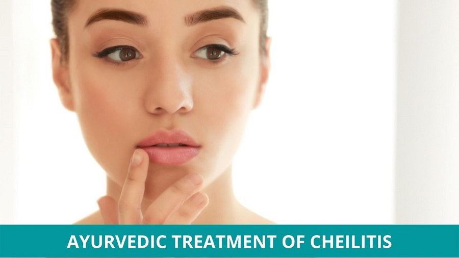 Ayurvedic Treatment of Cheilitis