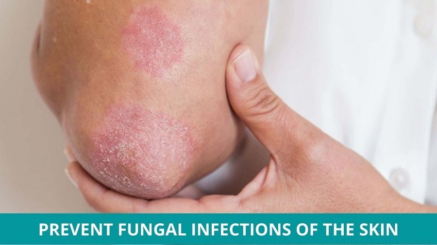 Prevent Fungal Infections of the Skin Naturally