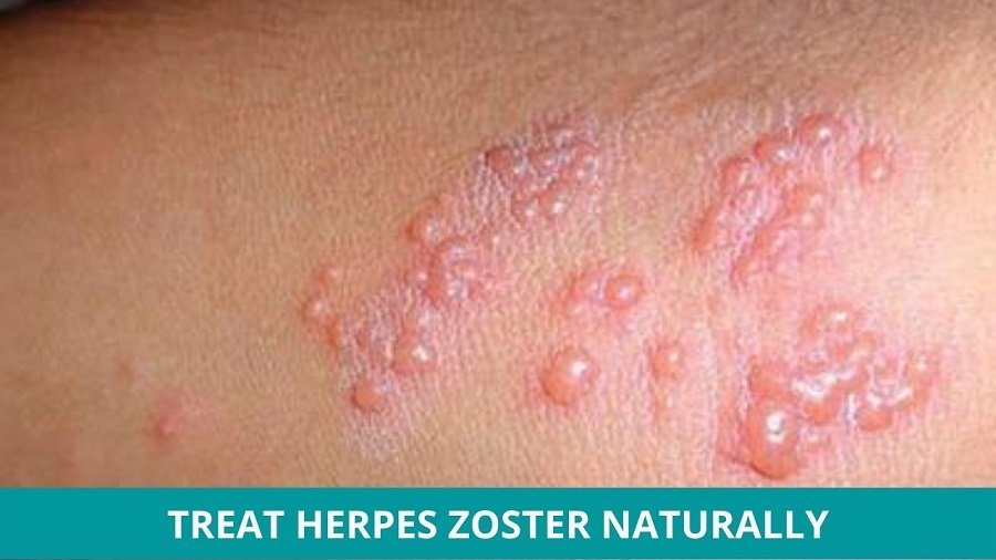 How to Treat Herpes Zoster Naturally?