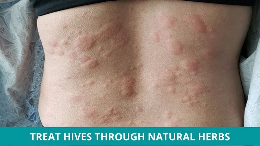 Treat Hives through Natural Herbs
