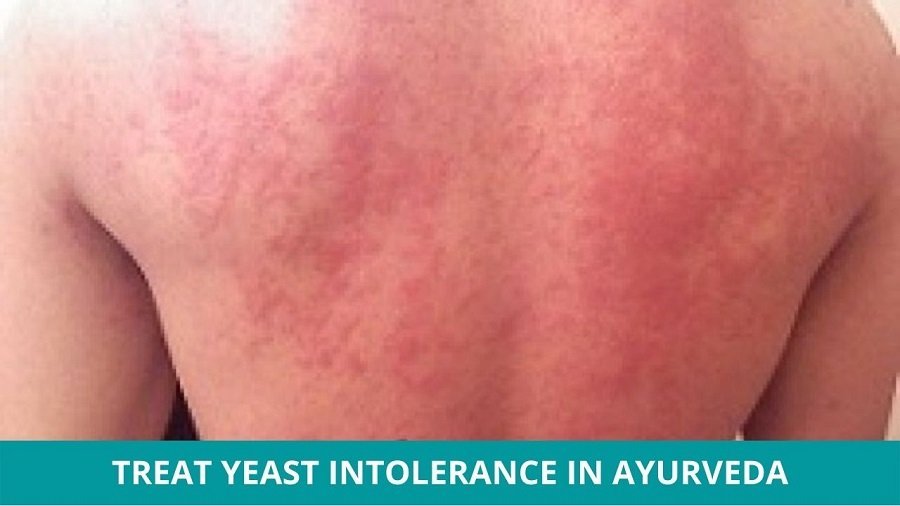Yeast Intolerance Treatment in Ayurveda