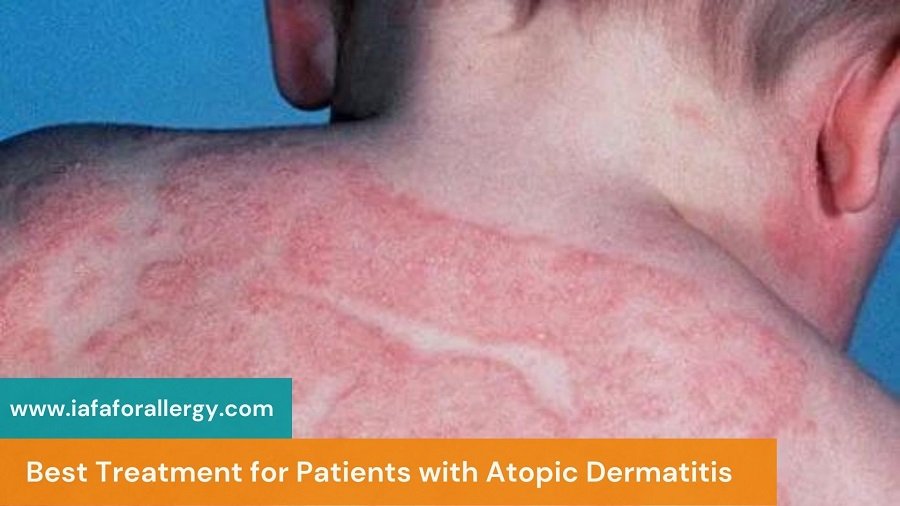 Best Treatment for Patients with Atopic Dermatitis