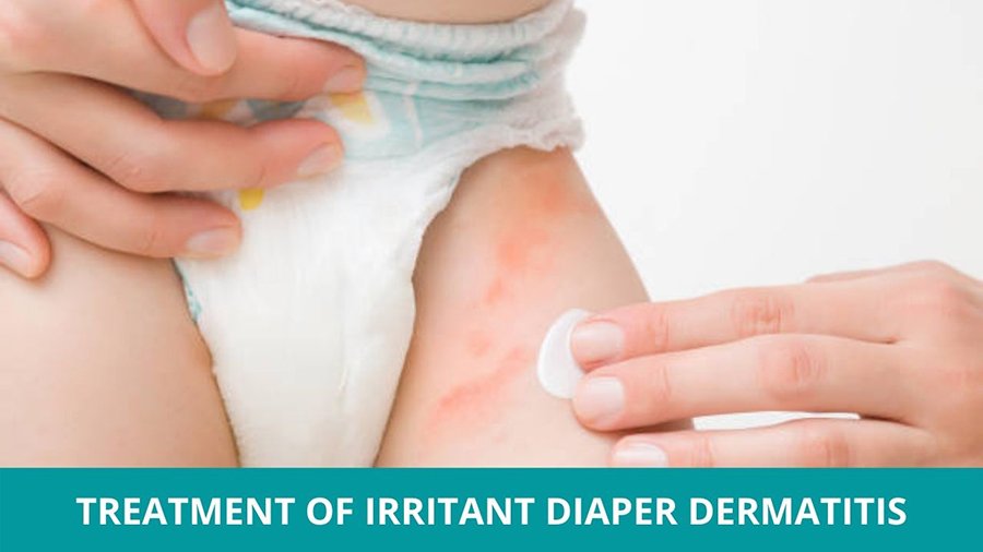 Treat Irritant Diaper Dermatitis in Ayurveda
