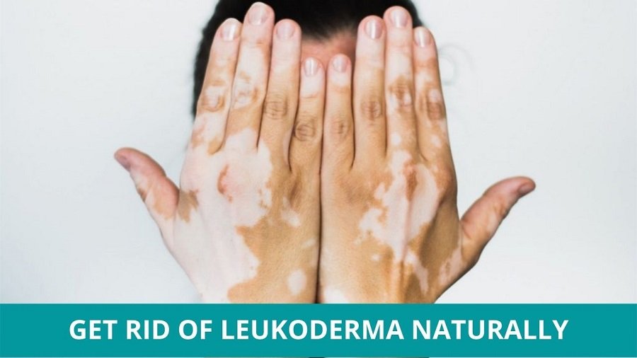 Get Rid of Leukoderma Naturally