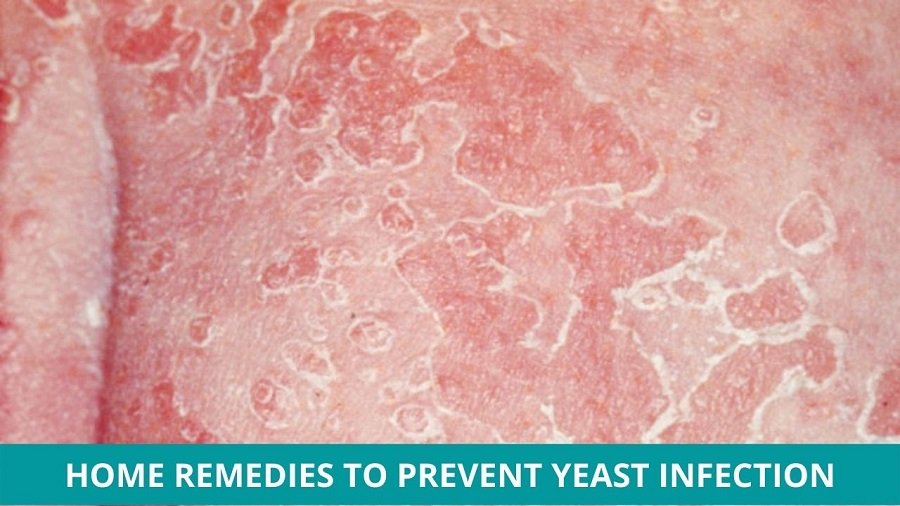 Prevent Yeast Infection through Home Remedies