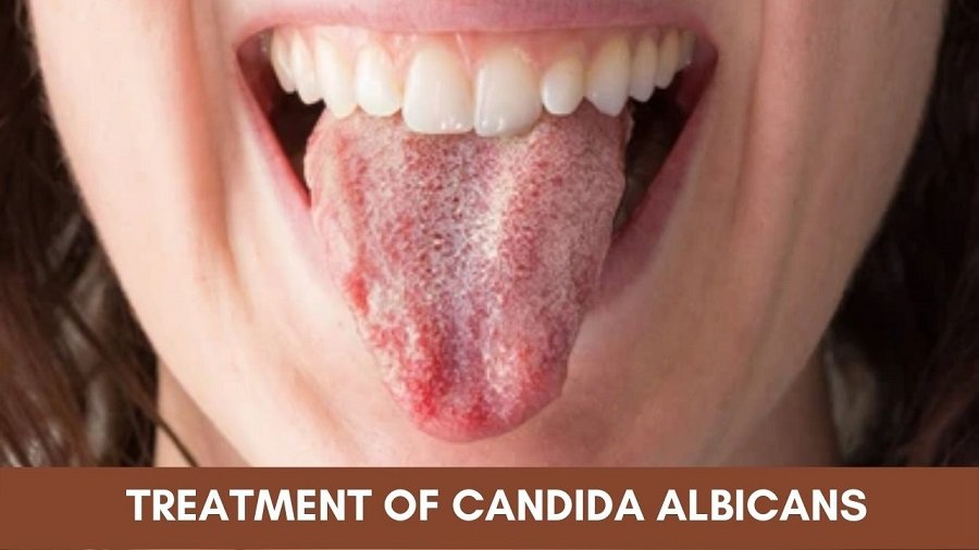Infection by candida albicans sales