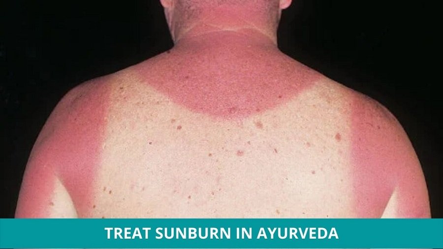 Sunburn Treatment in Ayurveda
