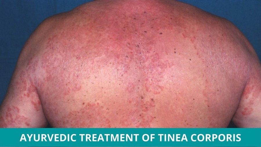 Ayurvedic Treatment of Tinea Corporis