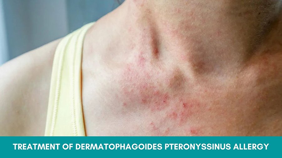 Treatment of Dermatophagoides Pteronyssinus Allergy