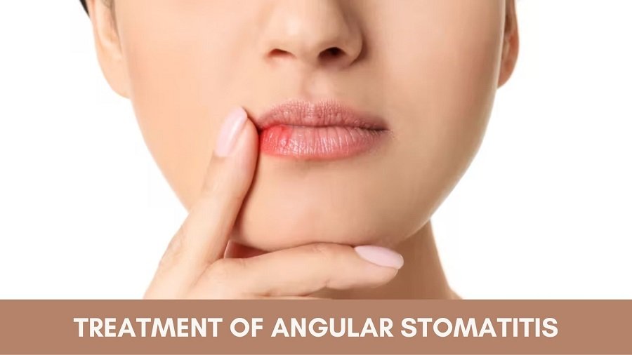 Ayurvedic Treatment of Angular Stomatitis