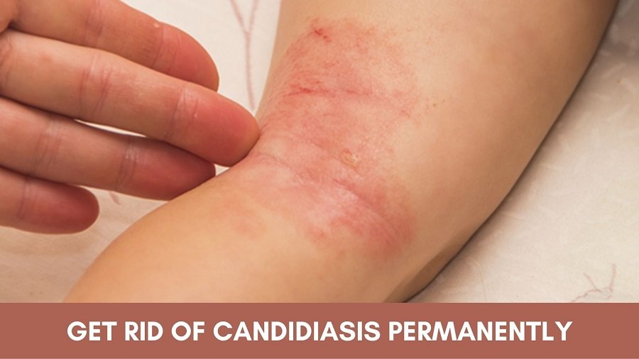 Get Rid of Candidiasis Permanently