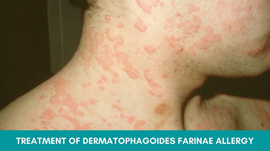 Ayurvedic Treatment of Dermatophagoides Farinae Allergy