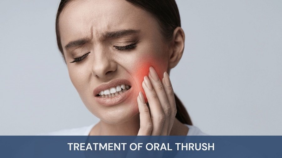 Treatment of Oral Thrush