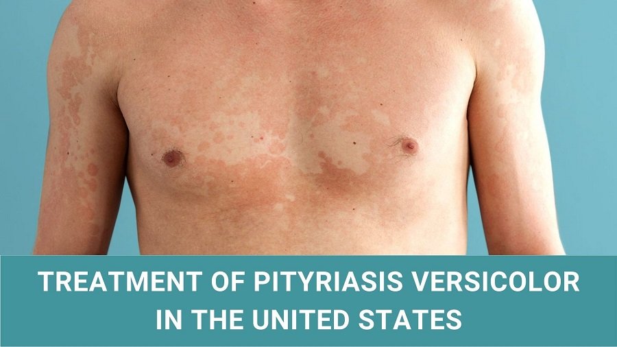 Treatment of Pityriasis Versicolor