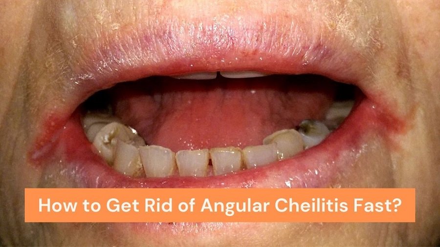 How to Get Rid of Angular Cheilitis Fast?