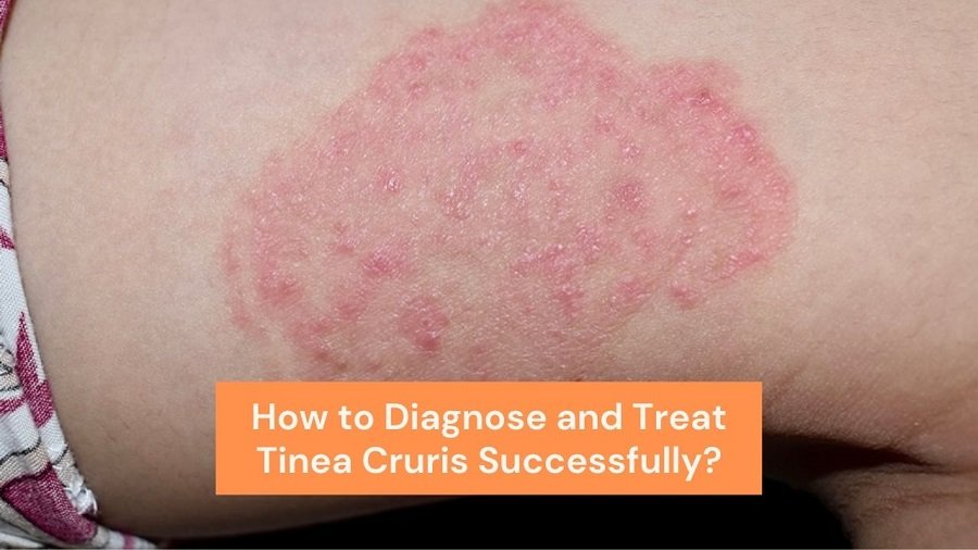 How to Diagnose and Treat Tinea Cruris Successfully?