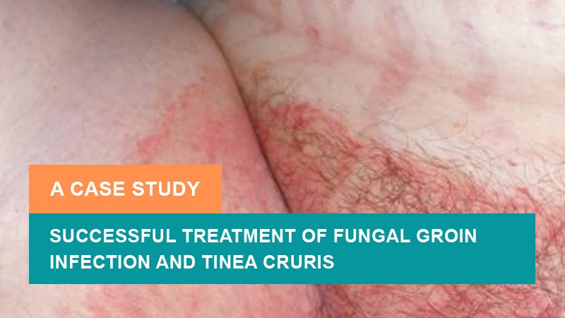 Successful Treatment of Fungal Groin Infection and Tinea Cruris - A Case Study