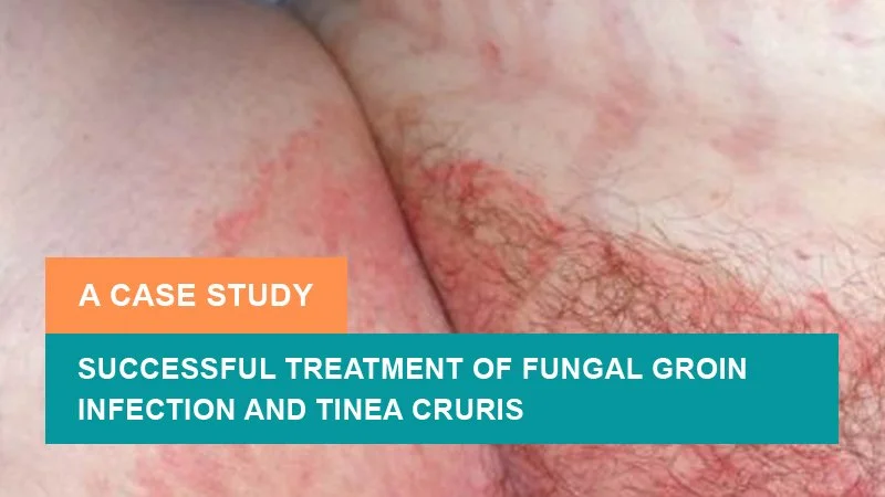 Tinea Cruris Female The Brief Case: A Case Of Tinea Corporis Caused By