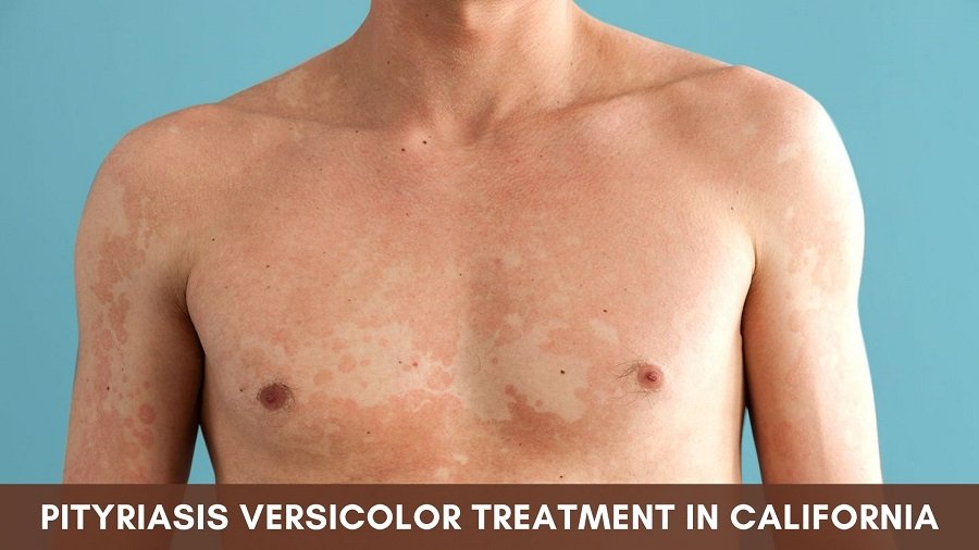 Pityriasis Versicolor Treatment in California