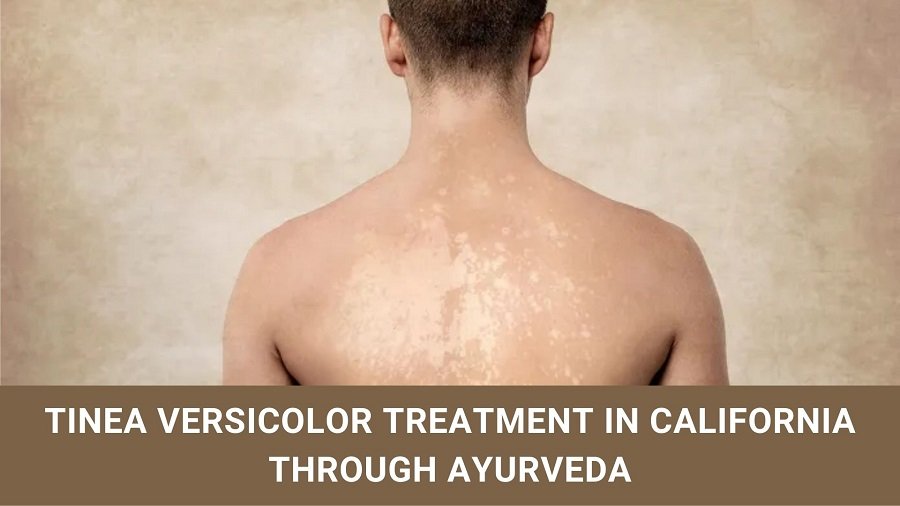 Tinea Versicolor Treatment in California through Ayurveda