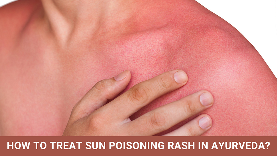 How to Treat Sun Poisoning Rash in Ayurveda?