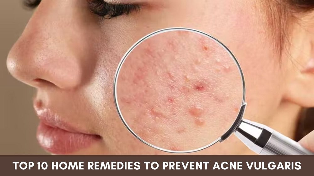 Top 10 Home Remedies to Prevent Acne Vulgaris