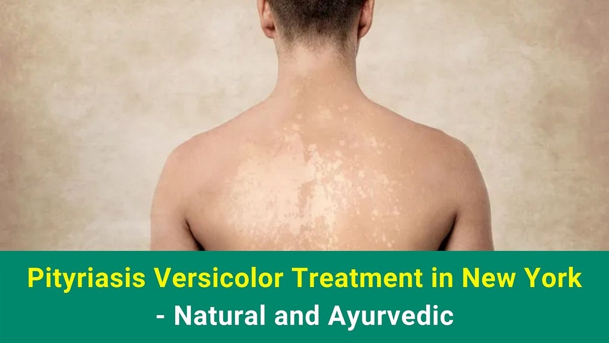 Pityriasis Versicolor Treatment in New York - Natural and Ayurvedic